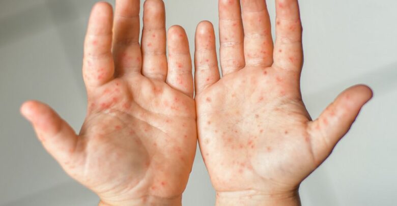 India's 3rd Case Of Monkeypox Confirmed In Man Who Returned To Kerala From UAE
